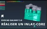 [EXOCAD] Tutoriel : comment créer des Inlay core avec scanpost sur Galway 3.0 de 3D Dental Store